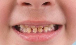 Thuốc có thể khiến răng đổi màu