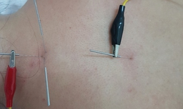 Giảm đau cổ vai gáy bằng châm cứu theo Tam pháp Đại chùy