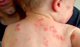  T&#236;m ra nguy&#234;n nh&#226;n g&#226;y bệnh eczema