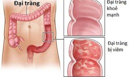 Biểu hiện bệnh đại tràng?
