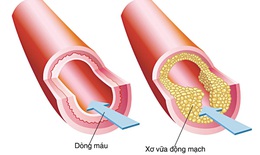 Cách nhìn mới về xơ vữa động mạch