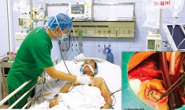 Cứu sống bệnh nhân thủng vách liên thất rất lớn do nhồi máu cơ tim hiếm gặp