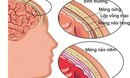 Tác nhân gây viêm màng não mủ