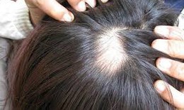 Thuốc chữa rụng tóc có hại cho trẻ?