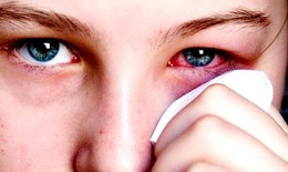 Cách trị viêm kết mạc họng hạch