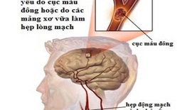 Bệnh mạch máu não:  Phòng ngừa từ các yếu tố nguy cơ