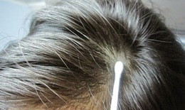Nấm da đầu - nấm tóc: Dễ nhầm lẫn và gây mất thẩm mỹ