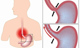 Điều trị trào ngược dạ dày - thực quản
