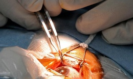Phẫu thuật đục thủy tinh thể: Cần chuẩn bị những gì?