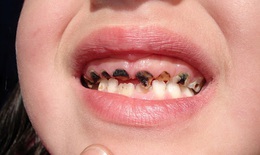 Ðừng để sâu răng gây hậu quả đáng tiếc cho trẻ