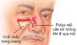 Polyp mũi có nguy hiểm?