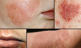 Bệnh eczema có chữa dứt điểm được không?