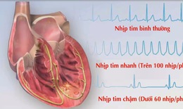 Thiết bị xác định rối loạn nhịp tim