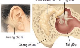 Viêm tai xương chũm cấp