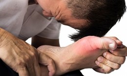 Bệnh gút ngày càng gia tăng và khó điều trị, tại sao?