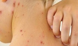Phòng và trị một số bệnh ngoài da