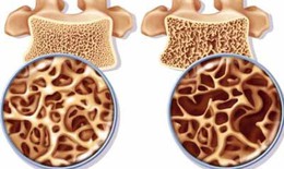 Cách nào khắc phục xốp xương do thuốc?
