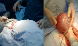 Hà Tĩnh: Phẫu thuật liên tiếp 2 bệnh nhân có khối u nang buồng trứng “khủng”