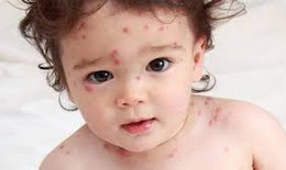 Chăm sóc bé bị thủy đậu