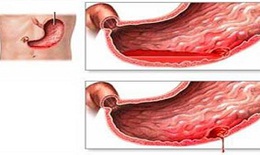 Thiết bị nội soi kiểm soát chảy máu đường tiêu hóa
