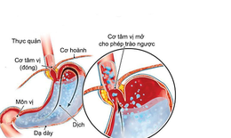 Bệnh GERD là bệnh gì?