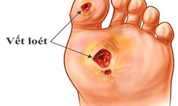 C&#244;ng nghệ nano - Hướng mới trong điều trị đ&#225;i th&#225;o đường