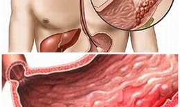 Phương pháp không xâm lấn phát hiện nhanh chảy máu dạ dày