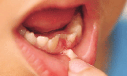 Hậu quả khi mất răng sữa sớm