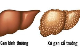Ðông y hỗ trợ trị xơ gan cổ trướng