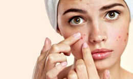 Mụn trứng cá - nỗi phiền muộn của làn da