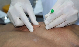 Thủy châm: Phương pháp điều trị  kết hợp y học hiện đại và y học cổ truyền