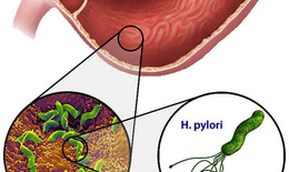 Chọn kháng sinh diệt vi khuẩn H.Pylori hiệu quả
