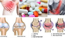 Dùng thuốc trị bệnh viêm xương khớp mùa lạnh và những lưu ý đặc biệt