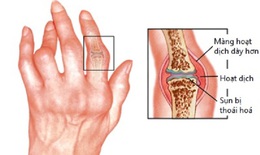 B&#224;i thuốc trị sưng đau c&#225;c khớp