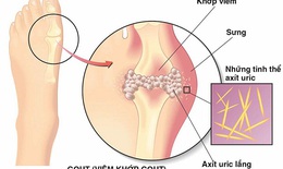 Bệnh g&#250;t, c&#225;c sai lầm thường gặp
