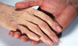 Đồi mồi trên da tay có nên tẩy?