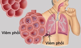 Các bệnh phổi do Lupus ban đỏ