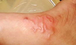 Bệnh nhiễm giun lươn có thể biến chứng nặng