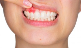 Viêm nướu răng nguy hiểm thế nào?