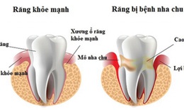 Viêm nha chu -Coi chừng mất răng…