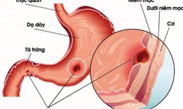 D&#249;ng thuốc dự ph&#242;ng lo&#233;t đường ti&#234;u h&#243;a do corticoid