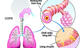 Cần hiểu rõ hơn về bệnh phổi tắc nghẽn mạn tính
