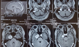 Phẫu thuật thành công khối u não hiểm hiếm gặp