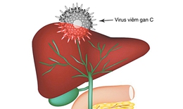 Viêm gan siêu vi C nguy hiểm đến mức nào?