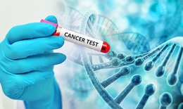 Xét nghiệm di truyền giúp phụ nữ mắc ung thư vú tránh phải hóa trị liệu