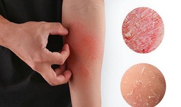 Các bệnh da thường gặp vào mùa lạnh