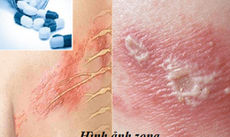 Trị bệnh zona, dùng thuốc kháng virus thế nào?