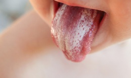 Ðiều trị nấm lưỡi ở trẻ