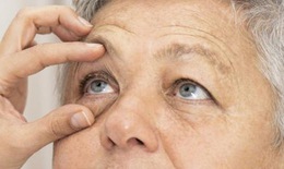 Sau phẫu thuật mắt bao lâu có thể chơi thể thao?