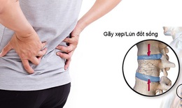 Những tiến bộ trong điều trị xẹp đốt sống lưng do loãng xương